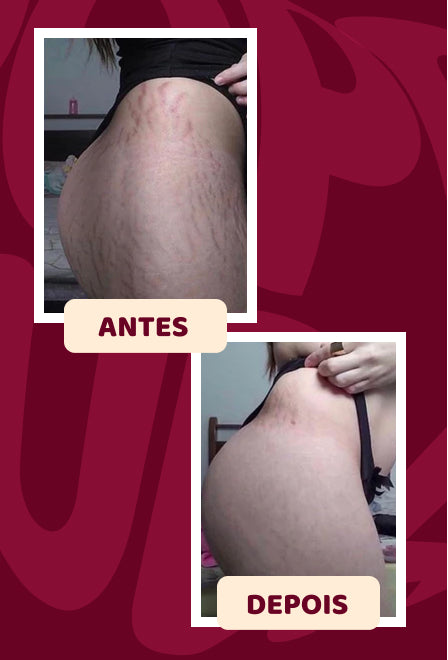 POPOZUDA AYUDA A ELIMINAR CELULITIS Y ESTRÍAS