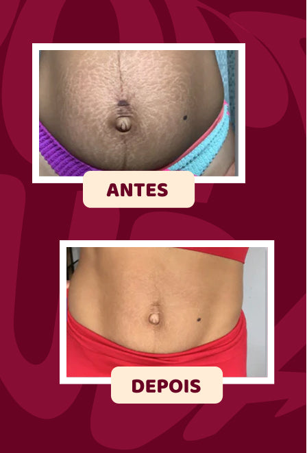 POPOZUDA AYUDA A ELIMINAR CELULITIS Y ESTRÍAS